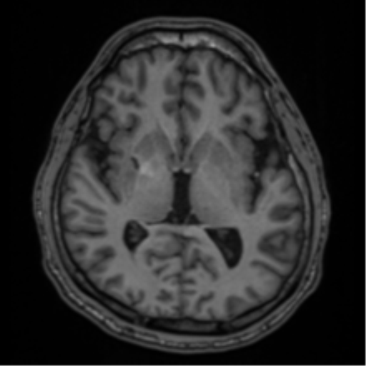 CNS vasculitis (Radiopaedia 55715-62263 Axial T1 29).png