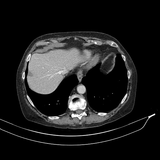 Calcified adrenal glands and Spigelian hernia (Radiopaedia 49741-54988 A 26).jpg