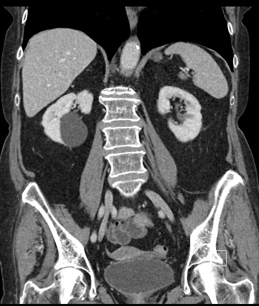 Calcified adrenal glands and Spigelian hernia (Radiopaedia 49741-54988 B 69).jpg