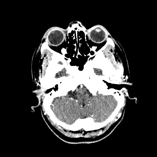 Calcified cerebral hydatid cyst (Radiopaedia 65603-74717 Axial with contrast 8).jpg