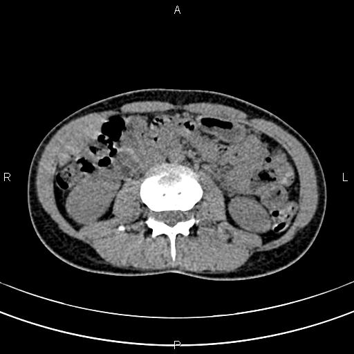 File:Calcified hepatic hydatid cyst (Radiopaedia 83870-99072 Axial non-contrast 89).jpg