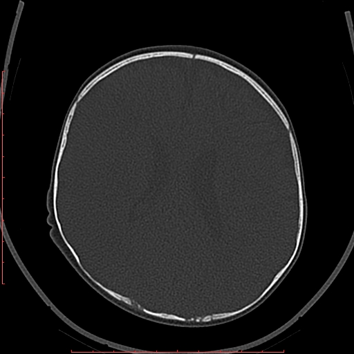 File:Calcified middle cerebral artery embolism (Radiopaedia 78949-91860 Axial bone window 43).jpg
