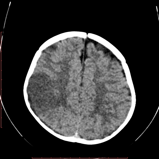 File:Calcified middle cerebral artery embolism (Radiopaedia 78949-91860 Axial non-contrast 19).jpg