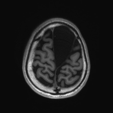 Callosal dysgenesis with interhemispheric cyst (Radiopaedia 53355-59335 Axial T1 133).jpg