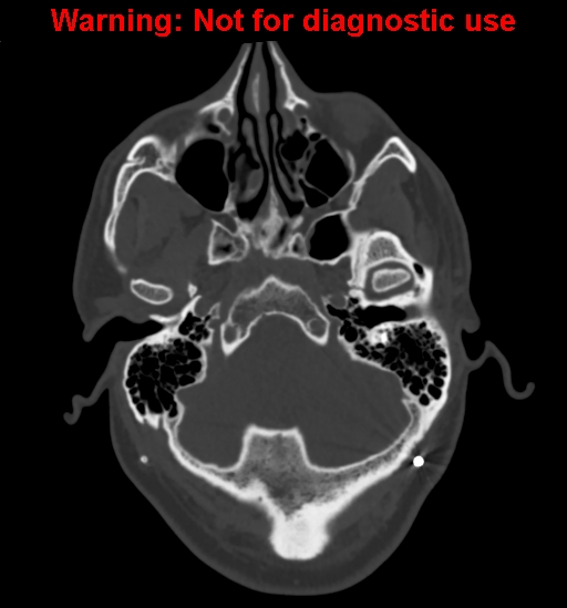 Calvarial thickening from chronic shunting (Radiopaedia 60079-67637 Axial bone window 28).jpg