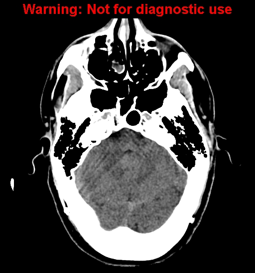 File:Calvarial thickening from chronic shunting (Radiopaedia 60079-67637 Axial non-contrast 8).jpg