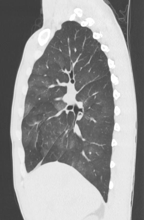 Cannabis-induced diffuse alveolar hemorrhage (Radiopaedia 89834-106946 Sagittal lung window 49).jpg