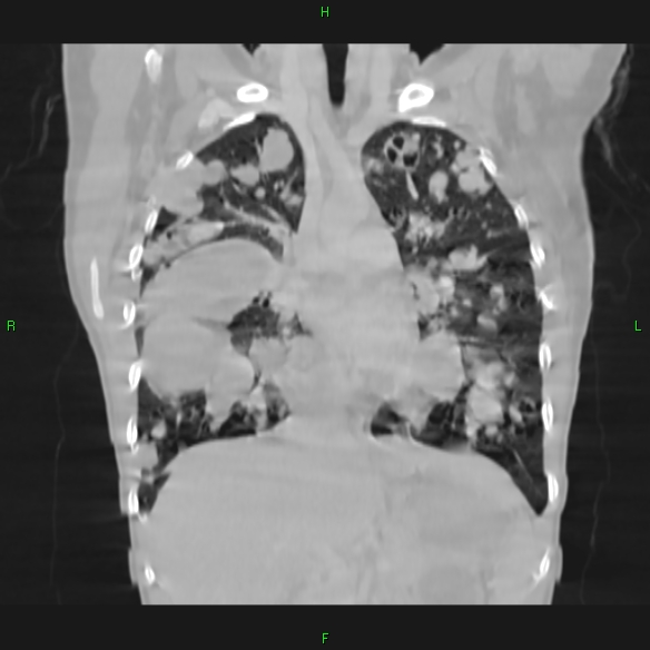File:Cannon ball metastases - synovial sarcoma (Radiopaedia 26135-26271 Coronal lung window 7).jpg