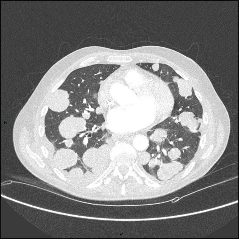 Cannonball metastases (Radiopaedia 82110-96150 Axial lung window 118).jpg