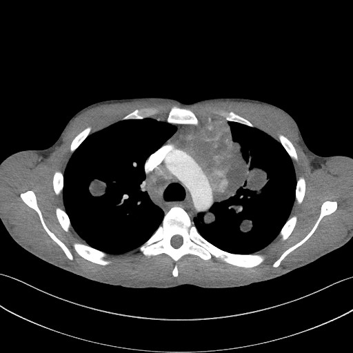 Cannonball metastases - testicular choriocarcinoma (Radiopaedia 84510-99891 B 44).jpg