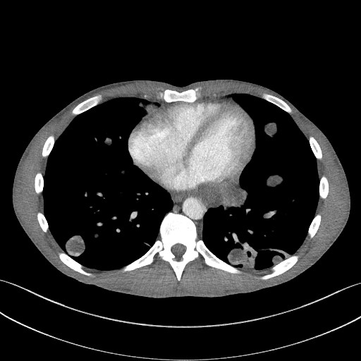 Cannonball metastases - testicular choriocarcinoma (Radiopaedia 84510-99891 B 76).jpg