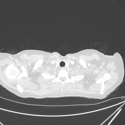 Canonball lung metastasis (Radiopaedia 77634-89837 Axial lung window 10).jpg