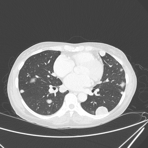 Canonball lung metastasis (Radiopaedia 77634-89837 Axial lung window 104).jpg