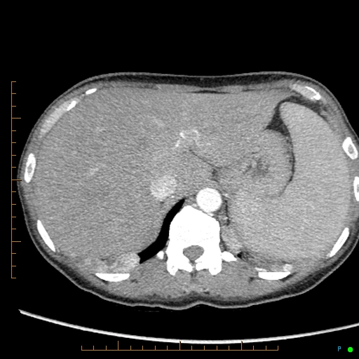 Canonball lung metastasis (Radiopaedia 77634-89837 B 96).jpg