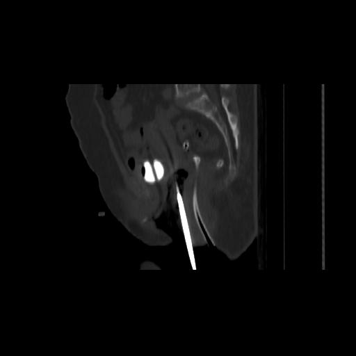 Carcinoma cervix- brachytherapy applicator (Radiopaedia 33135-34173 Sagittal bone window 91).jpg
