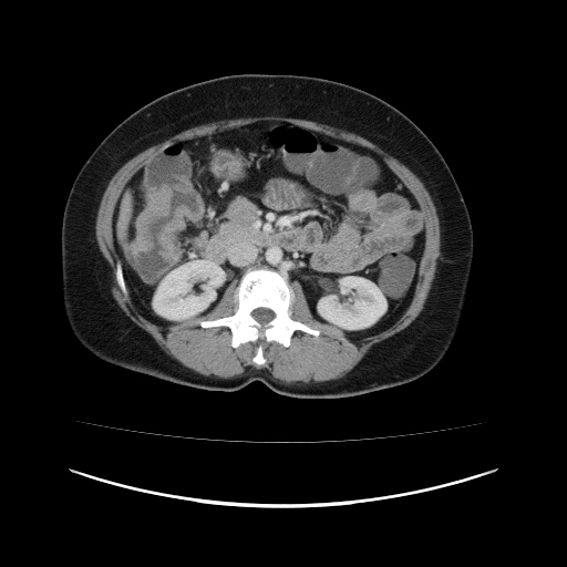 Carcinoma colon - hepatic flexure (Radiopaedia 19461-19493 A 55).jpg