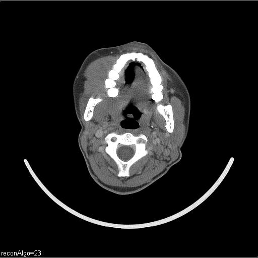 File:Carcinoma of the maxillary antrum (Radiopaedia 53805-59888 Axial C+ delayed 40).jpg