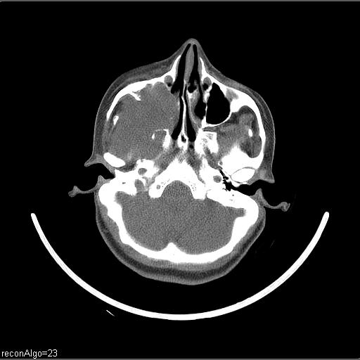 File:Carcinoma of the maxillary antrum (Radiopaedia 53805-59888 Axial non-contrast 63).jpg