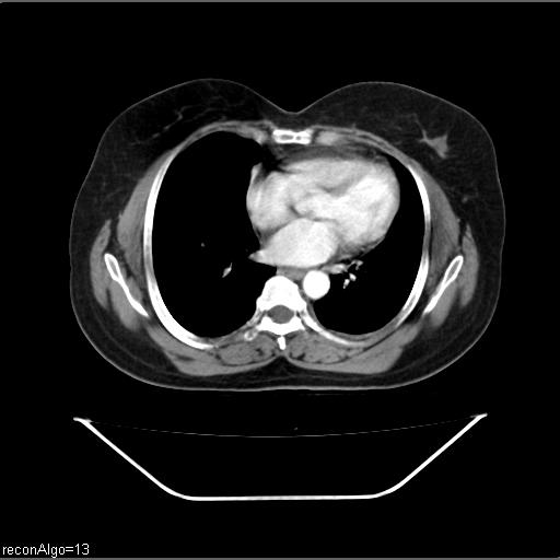File:Carcinoma of uterine cervix (Radiopaedia 37082).jpg