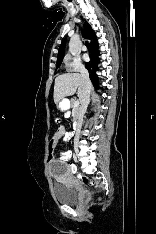 Carcinoma of uterine cervix (Radiopaedia 85861-101700 D 35).jpg
