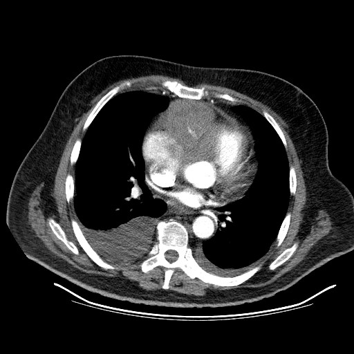 File:Cardiac lymphoma (Radiopaedia 38690-40836 Axial C+ CTPA 10).jpg