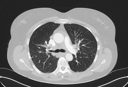 File:Cardiac sarcoidosis (Radiopaedia 74548-85534 Axial lung window 32).jpg