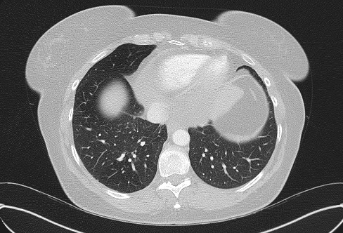 File:Cardiac sarcoidosis (Radiopaedia 74548-85534 Axial lung window 68).jpg