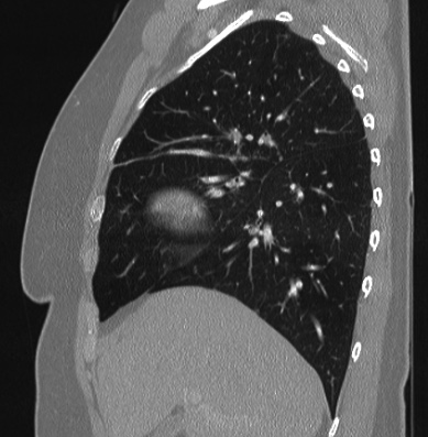 Cardiac sarcoidosis (Radiopaedia 74548-85534 Sagittal lung window 66).jpg