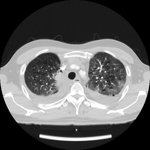 Cardiac tamponade (Radiopaedia 78607-91368 Axial lung window 15).jpg