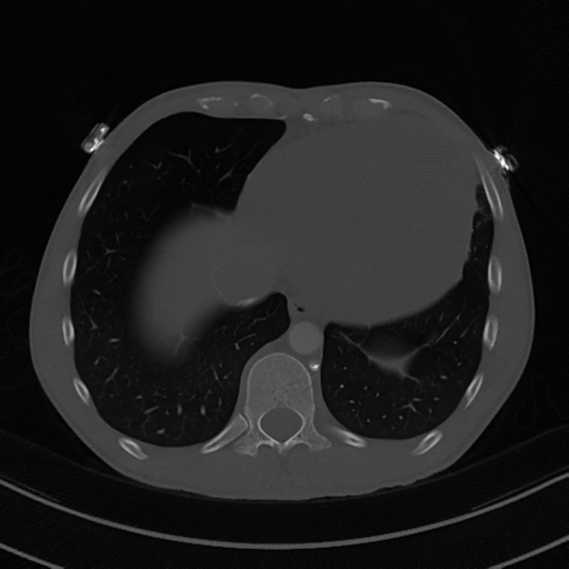 Cardiac tumor - undifferentiated pleomorphic sarcoma (Radiopaedia 45844-50134 Axial bone window 55).png