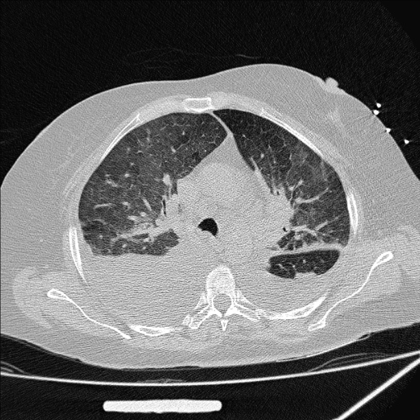 Cardiogenic pulmonary edema (Radiopaedia 29213-29609 Axial lung window 32).jpg