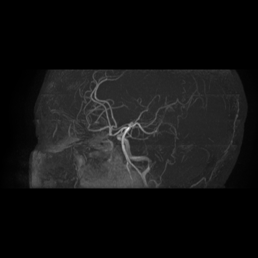 Carotid arterial dissection with acute cerebral infarction (Radiopaedia 26636-26784 MRA 6).jpg