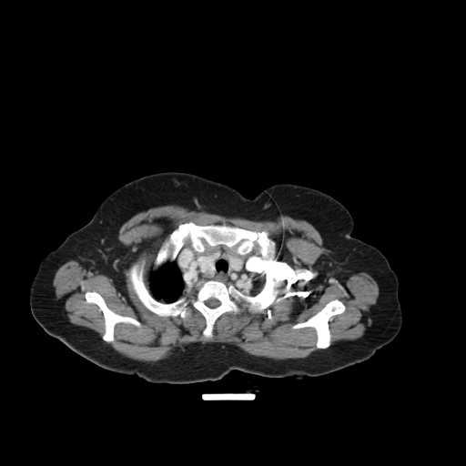 File:Carotid body tumor (Radiopaedia 21021-20948 B 25).jpg