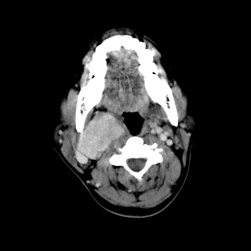 File:Carotid body tumor (Radiopaedia 27890-28124 A 13).jpg