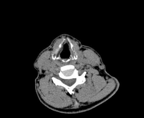 File:Carotid body tumor (Radiopaedia 61750-69757 Axial non-contrast 72).jpg