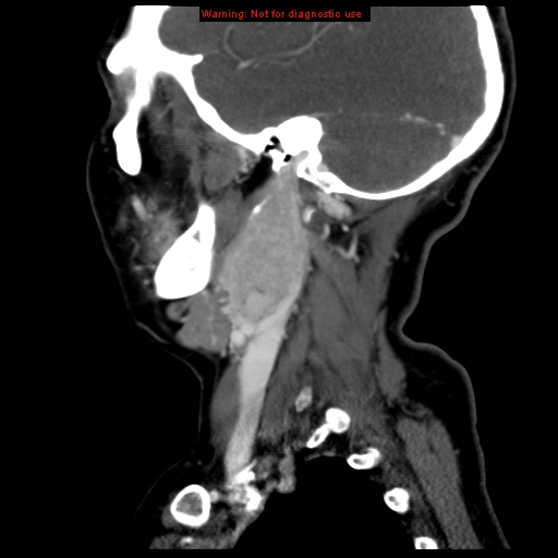 Carotid body tumor with lung metastases (Radiopaedia 9301-9986 Sagittal C+ delayed 39).jpg
