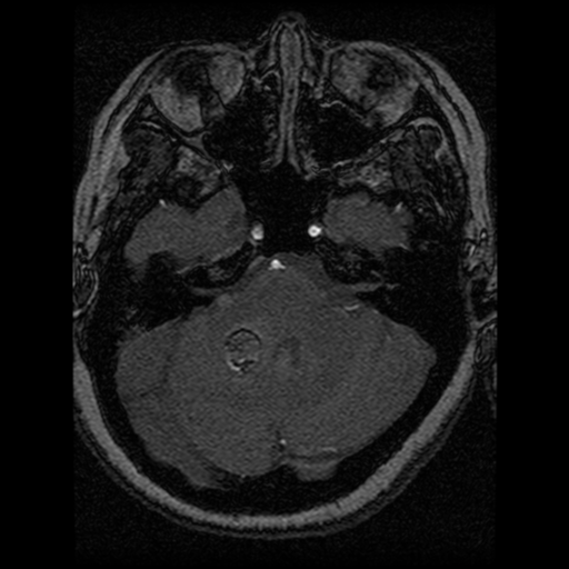 Cavernoma, DVA and right ICA aneurysm (Radiopaedia 33890-35072 E 77).png