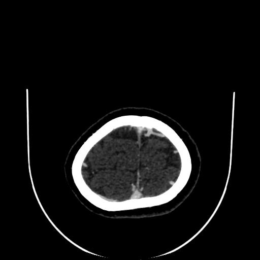 Cavernoma with developmental venous anomaly (Radiopaedia 22470-22506 C 184).jpg