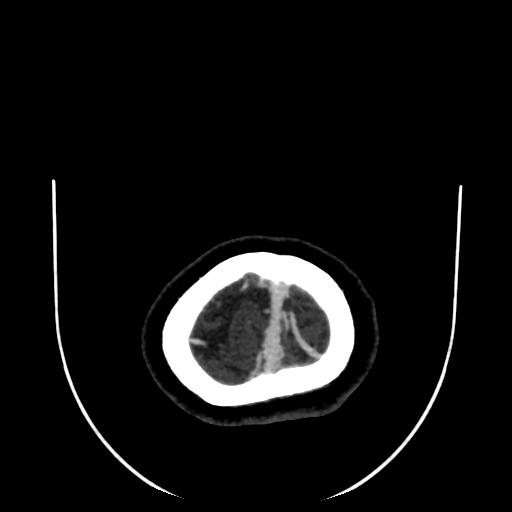 Cavernoma with developmental venous anomaly (Radiopaedia 22470-22506 C 195).jpg