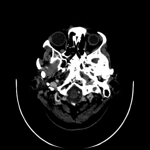 Cavernoma with developmental venous anomaly (Radiopaedia 22470-22506 C 2).jpg