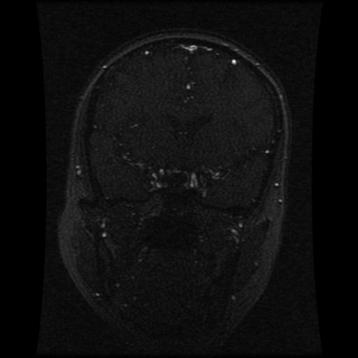 Cavernoma with developmental venous anomaly (Radiopaedia 22470-22507 MRV 85).jpg