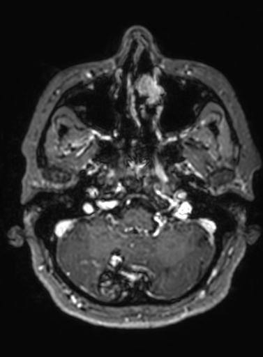 Cavernous hemangioma of the cerebellar falx (Radiopaedia 73025-83724 Axial T1 C+ 276).jpg