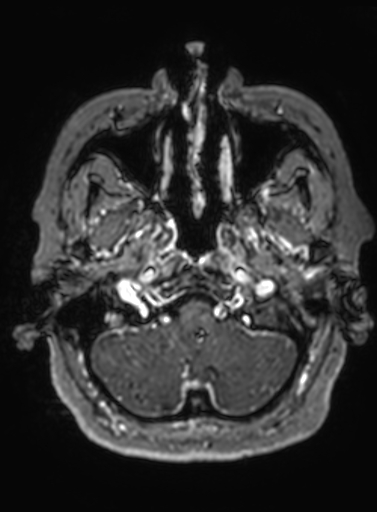 Cavernous hemangioma of the cerebellar falx (Radiopaedia 73025-83724 Axial T1 C+ 297).jpg