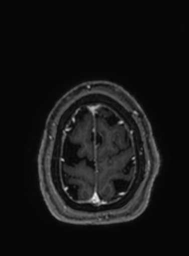 Cavernous hemangioma of the cerebellar falx (Radiopaedia 73025-83724 Axial T1 C+ 41).jpg