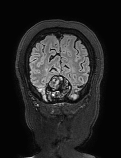 Cavernous hemangioma of the cerebellar falx (Radiopaedia 73025-83724 Coronal FLAIR 315).jpg