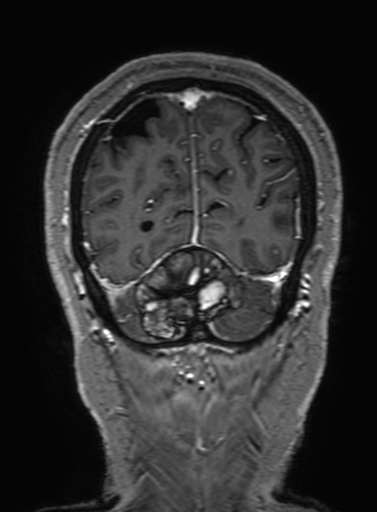 Cavernous hemangioma of the cerebellar falx (Radiopaedia 73025-83724 Coronal T1 C+ 321).jpg