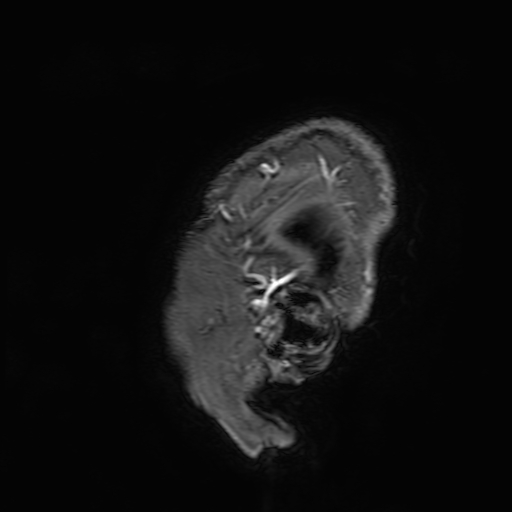File:Cavernous hemangioma of the cerebellar falx (Radiopaedia 73025-83724 Sagittal T1 C+ 3).jpg