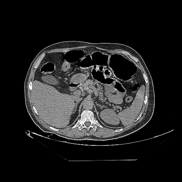 Cavitating bronchogenic carcinoma (Radiopaedia 44489-48162 Axial non-contrast 93).jpg