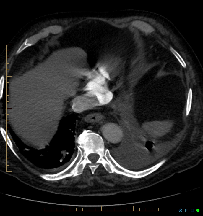 Cavitating pulmonary infarction (Radiopaedia 54634-60849 Axial C+ CTPA 68).jpg