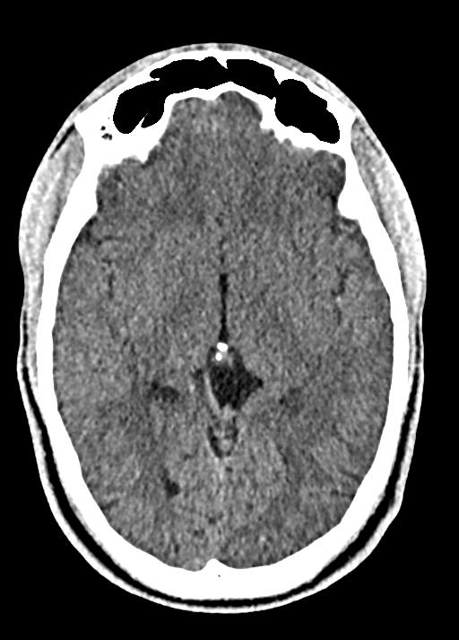 Cavum septum pellucidum and cavum vergae (Radiopaedia 77797-90060 Axial Brain Window 49).jpg